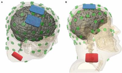 Cathodal tDCS Over Motor Cortex Does Not Improve Tourette Syndrome: Lessons Learned From a Case Series